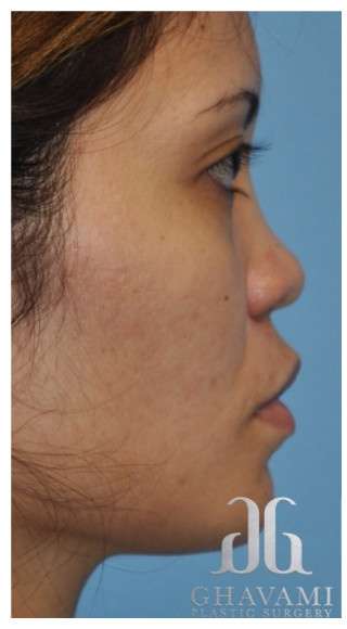 Ethnic Rhinoplasty Before & After Patient #6889