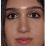 Ethnic Rhinoplasty Before & After Patient #6882