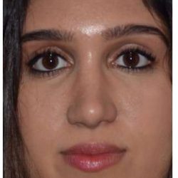 Ethnic Rhinoplasty Before & After Patient #6882