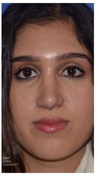Ethnic Rhinoplasty Before & After Patient #6882