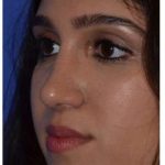 Ethnic Rhinoplasty Before & After Patient #6882