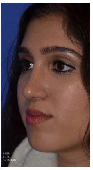 Ethnic Rhinoplasty Before & After Patient #6882