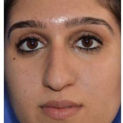 Ethnic Rhinoplasty Before & After Patient #6882
