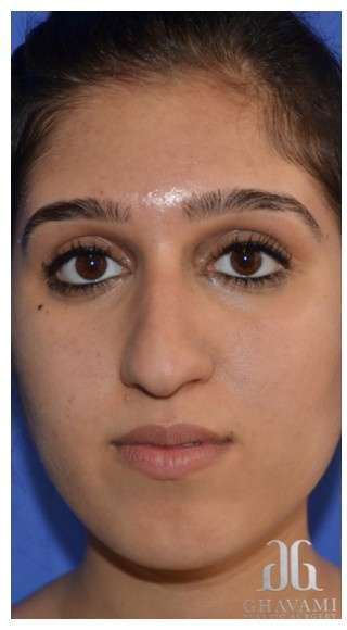 Ethnic Rhinoplasty Before & After Patient #6882