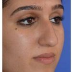 Ethnic Rhinoplasty Before & After Patient #6882