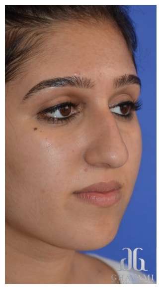 Ethnic Rhinoplasty Before & After Patient #6882