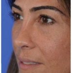 Rhinoplasty Before & After Patient #6877