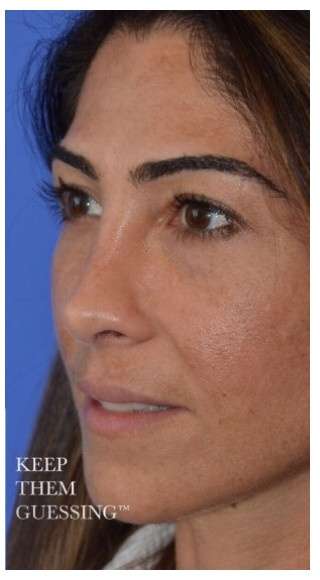 Rhinoplasty Before & After Patient #6877