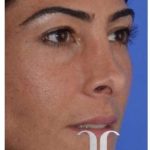 Rhinoplasty Before & After Patient #6877