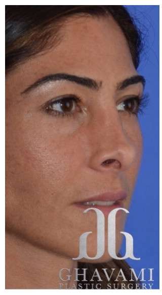 Rhinoplasty Before & After Patient #6877