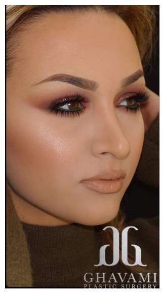 Ethnic Rhinoplasty Before & After Patient #6864