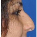 Rhinoplasty Before & After Patient #6861