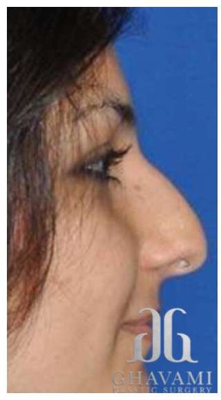 Rhinoplasty Before & After Patient #6861