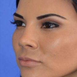 Ethnic Rhinoplasty Before & After Patient #6847