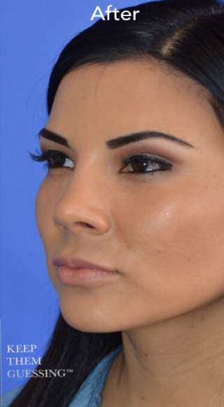 Ethnic Rhinoplasty Before & After Patient #6847