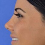 Ethnic Rhinoplasty Before & After Patient #6847