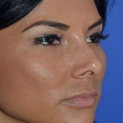Ethnic Rhinoplasty Before & After Patient #6847