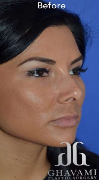 Ethnic Rhinoplasty Before & After Patient #6847