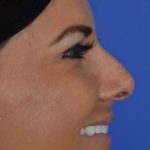 Ethnic Rhinoplasty Before & After Patient #6847