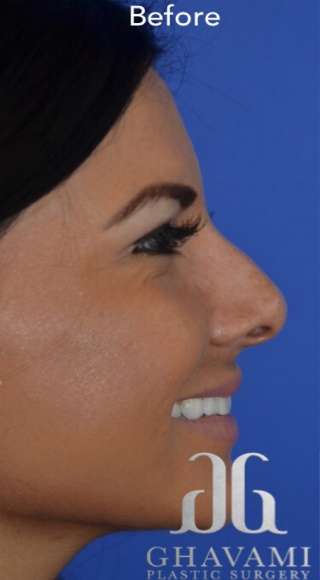 Ethnic Rhinoplasty Before & After Patient #6847