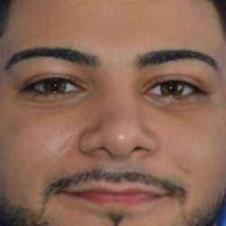 Male Rhinoplasty Before & After Patient #6842