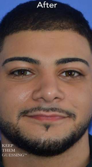 Male Rhinoplasty Before & After Patient #6842