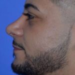 Male Rhinoplasty Before & After Patient #6842