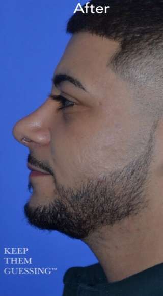 Male Rhinoplasty Before & After Patient #6842