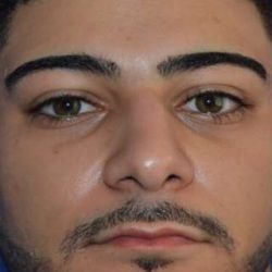 Male Rhinoplasty Before & After Patient #6842