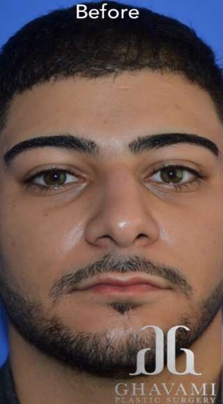 Male Rhinoplasty Before & After Patient #6842