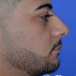 Male Rhinoplasty Before & After Patient #6842