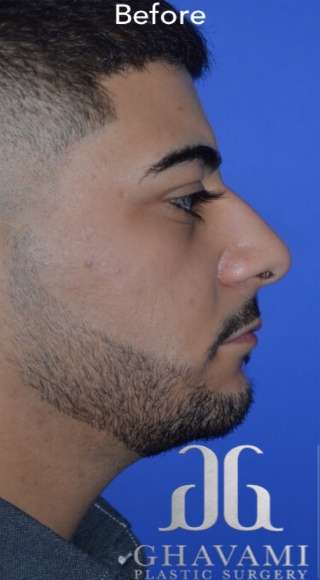 Male Rhinoplasty Before & After Patient #6842