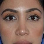 Ethnic Rhinoplasty Before & After Patient #6837