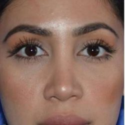 Ethnic Rhinoplasty Before & After Patient #6837