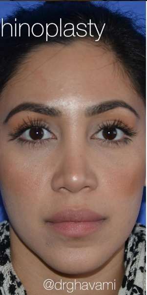 Ethnic Rhinoplasty Before & After Patient #6837