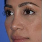 Ethnic Rhinoplasty Before & After Patient #6837