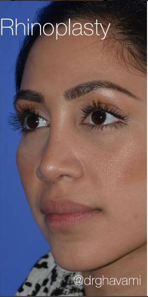 Ethnic Rhinoplasty Before & After Patient #6837