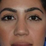 Ethnic Rhinoplasty Before & After Patient #6837