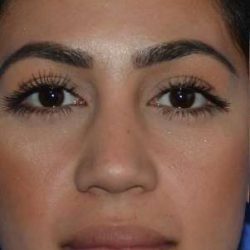 Ethnic Rhinoplasty Before & After Patient #6837