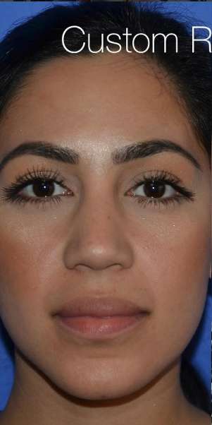 Ethnic Rhinoplasty Before & After Patient #6837