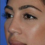 Ethnic Rhinoplasty Before & After Patient #6837