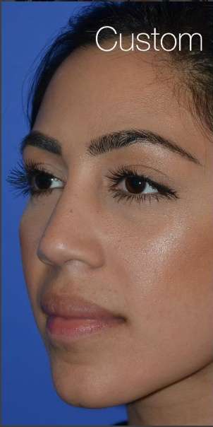 Ethnic Rhinoplasty Before & After Patient #6837
