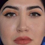 Ethnic Rhinoplasty Before & After Patient #6832