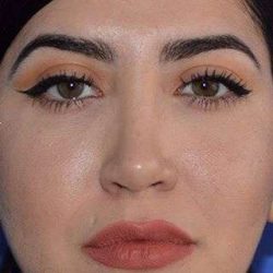 Ethnic Rhinoplasty Before & After Patient #6832