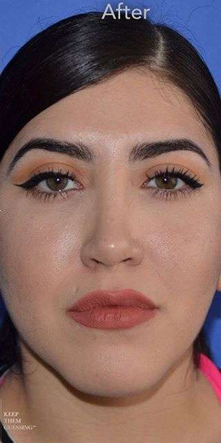 Ethnic Rhinoplasty Before & After Patient #6832