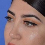Ethnic Rhinoplasty Before & After Patient #6832