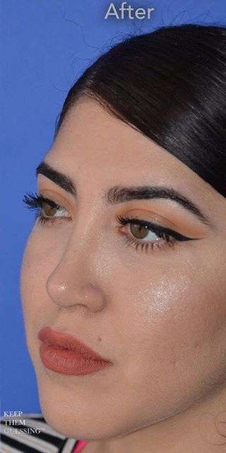 Ethnic Rhinoplasty Before & After Patient #6832