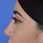 Ethnic Rhinoplasty Before & After Patient #6832