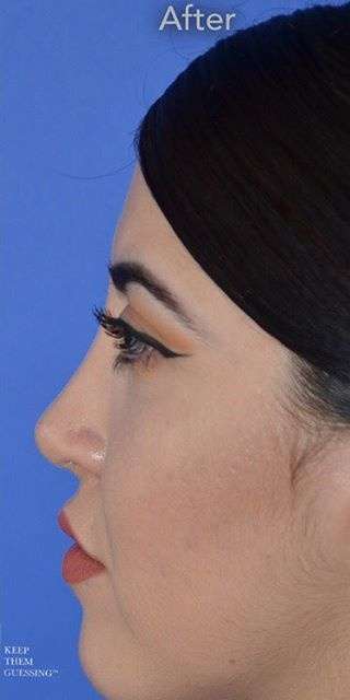 Ethnic Rhinoplasty Before & After Patient #6832