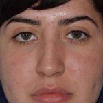 Ethnic Rhinoplasty Before & After Patient #6832